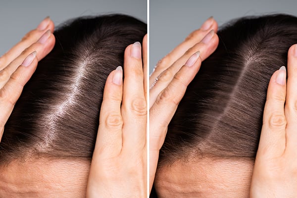 Platelet Rich Plasma (PRP) for Hair Loss Platelet Rich Plasma (PRP) for Hair Loss